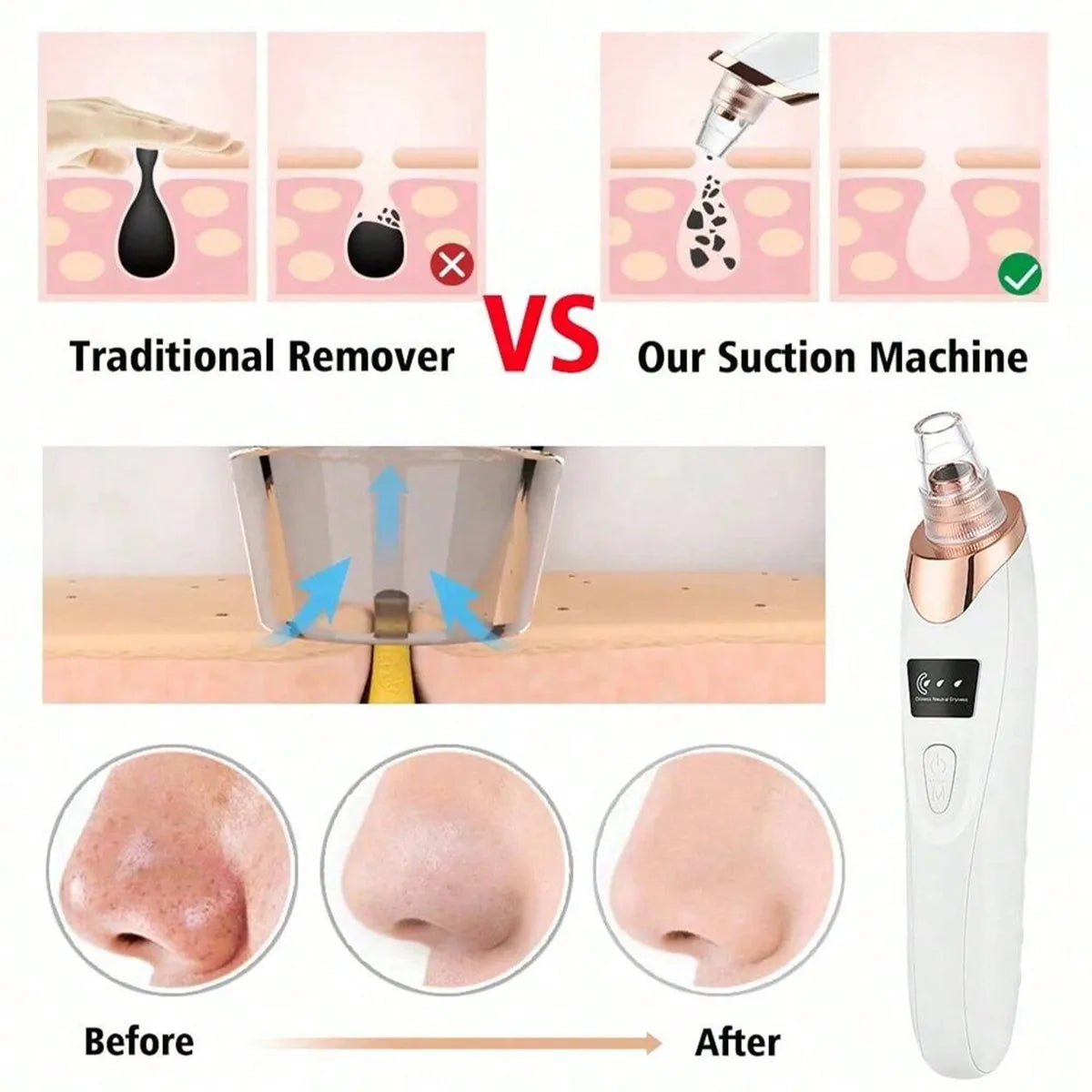 LumiClear™ Pore Vacuum – 5-Level Suction Blackhead Remover