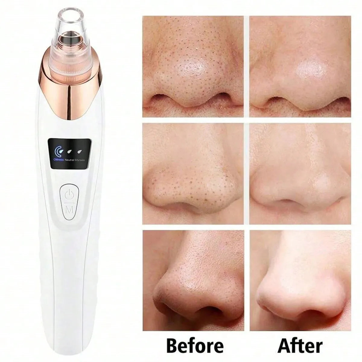 LumiClear™ Pore Vacuum – 5-Level Suction Blackhead Remover