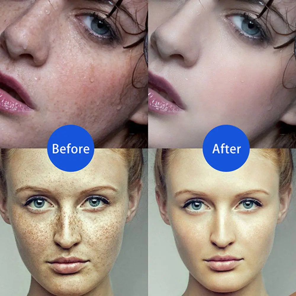 DermaLuxe Precision Spot Removal Pen